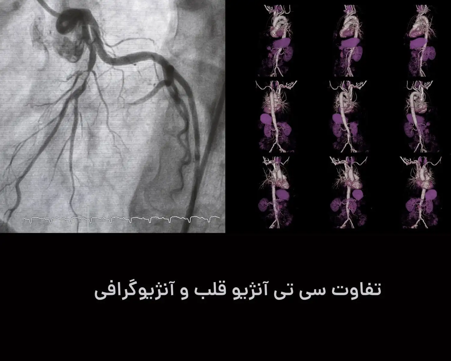 تفاوت-سی-تی-آنژیو-قلب-و-آنژیوگرافی