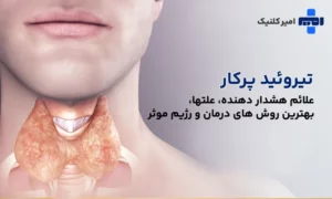 تیروئید پرکار