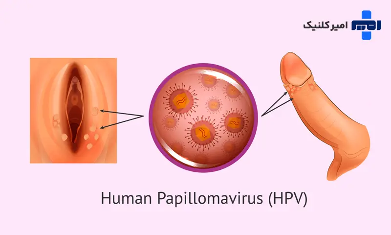 زگیل تناسلی